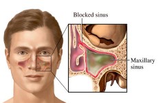 Atasi Penyakit Sinusitis dengan Cara Berikut Ini