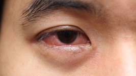3 Cara Mengatasi Kelopak Mata yang Sering Bengkak